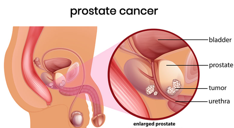 Prostate Cancer