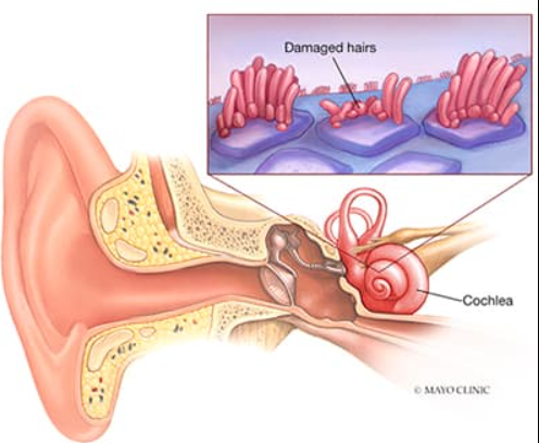 Hearing Loss