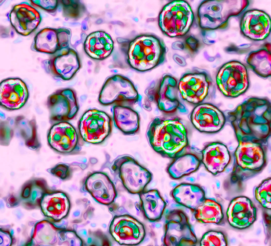 Cases Of Measles