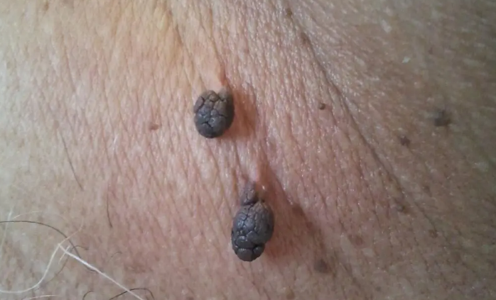 Skin Tags