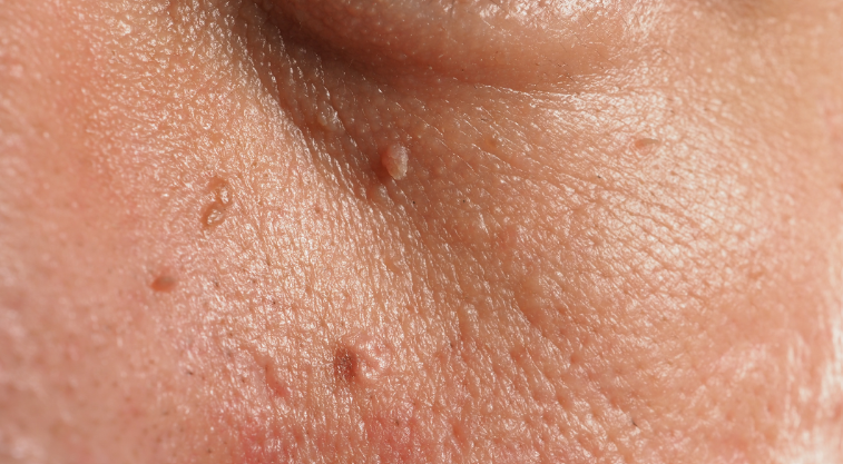 Skin Tags