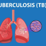 Tuberculosis