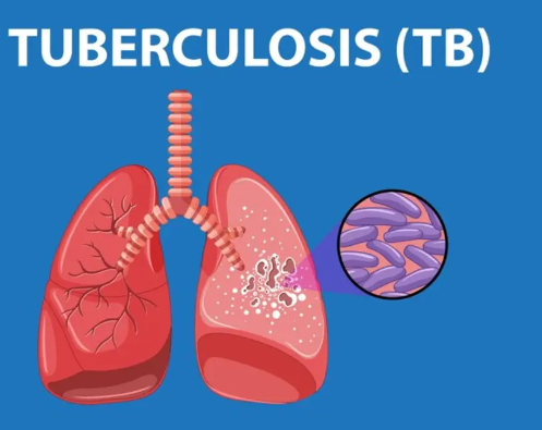 Tuberculosis