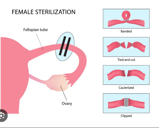 Sterilization 