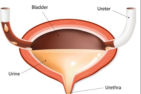 UTI