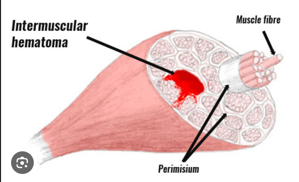 hemophilia