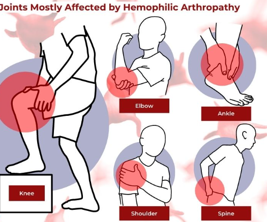 hemophilia