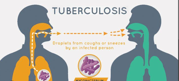 Tuberculosis