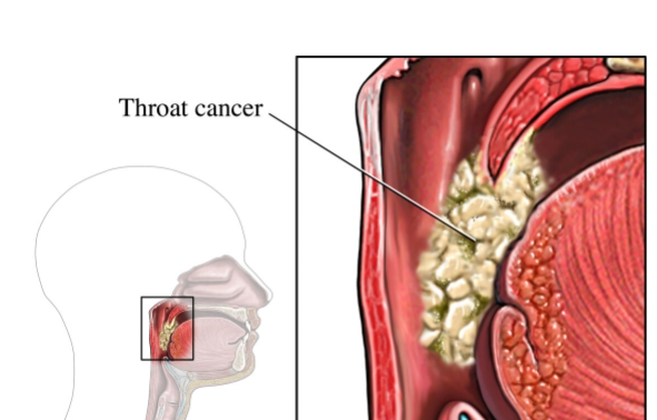 Neck Cancer