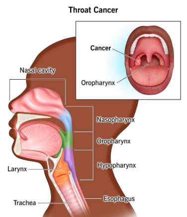 Neck Cancer