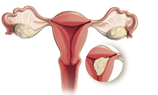 endometrial cancer,