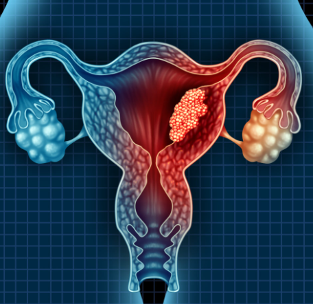 endometrial cancer,