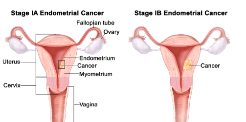 endometrial cancer,