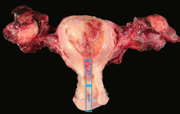 endometrial cancer,