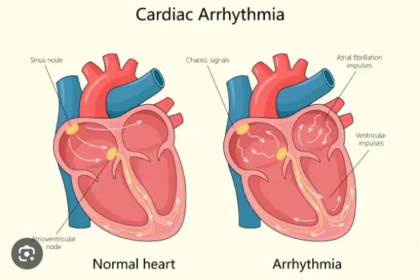 Heart Arrhythmias