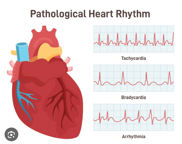 Heart Arrhythmias