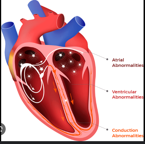 Heart Arrhythmias