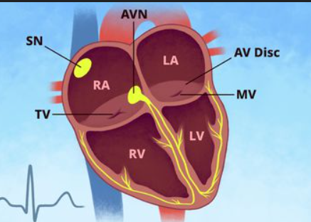 Heart Arrhythmias