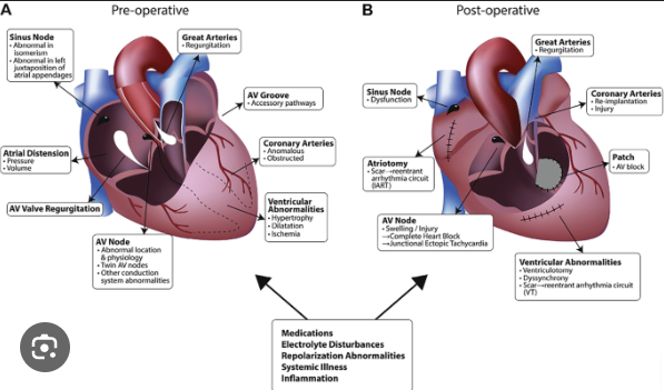 Heart Arrhythmias