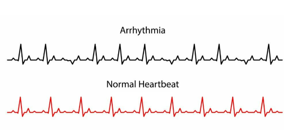 Heart Arrhythmias